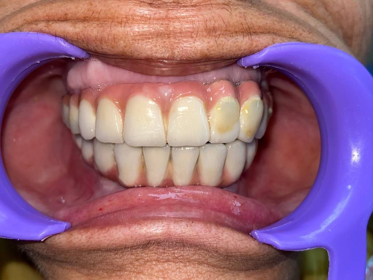 Full Mouth Implant 2 — after
